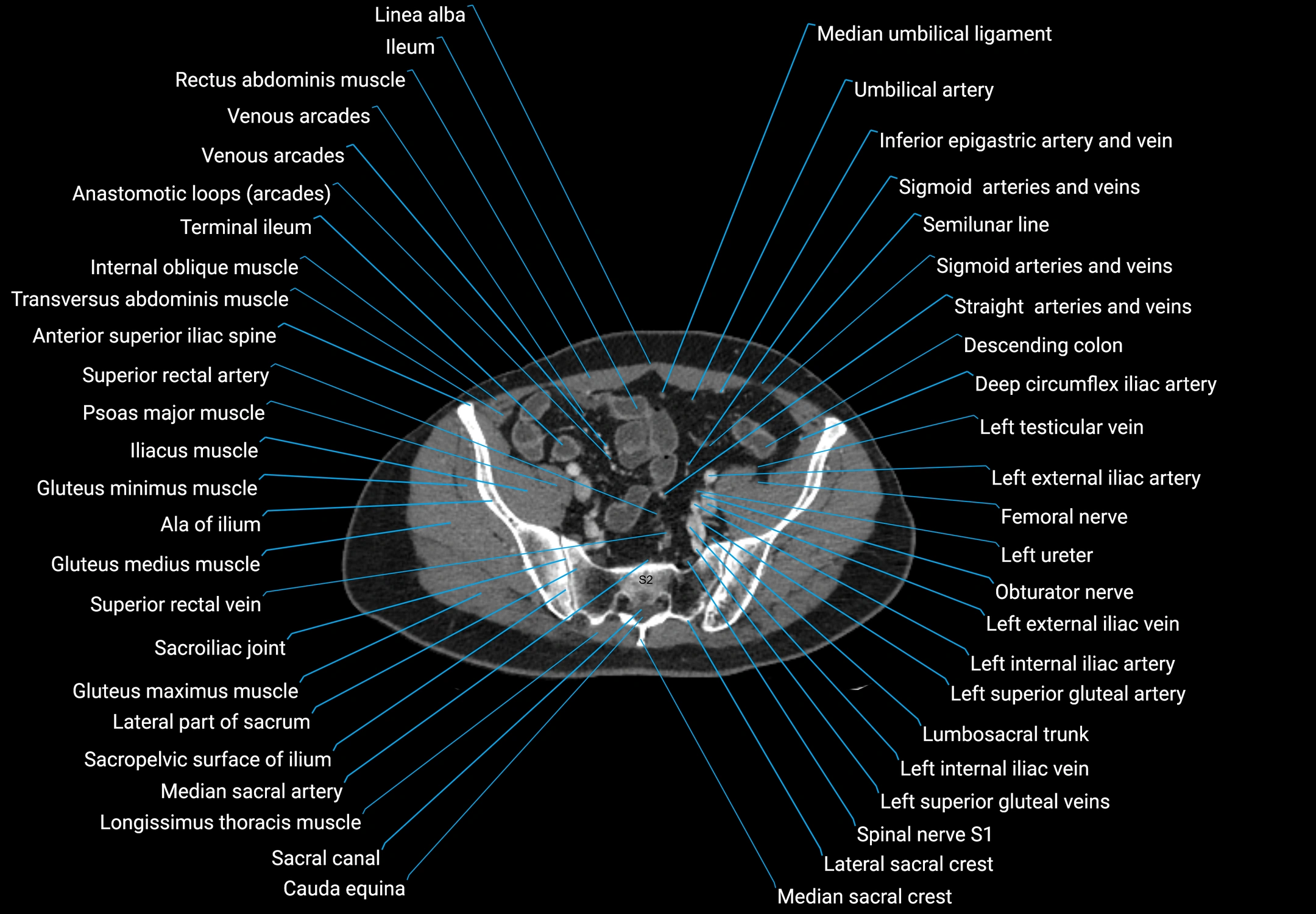 CT male pelvis axial cross sectional anatomy labelled radiology image -00152.webp